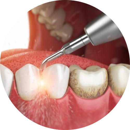 Удаляем зубной налет. 5 советов стоматолога