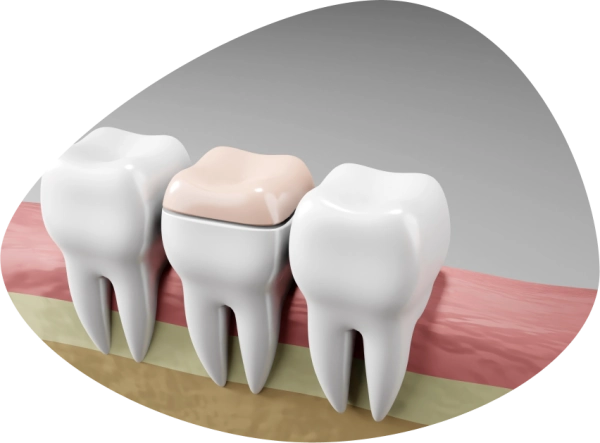 Микропротезирование зубов вкладками