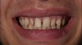 У ребенка коричневый налет на зубах - 16 ответов - Детское здоровье - Форум Дети витамин-п-байкальский.рф