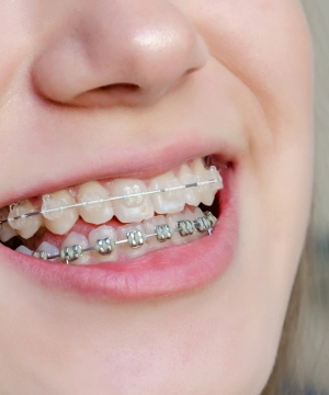Зуб треснул пополам, можно ли его спасти – статьи стоматологической клиники «Доктор Мартин»
