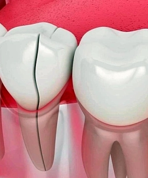 Что делать если шатается постоянный зуб? | Стоматология DentArt | Киев