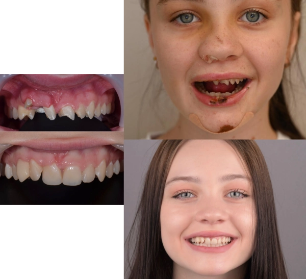 Травмы зубов у детей