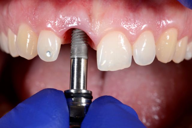 Когда можно ставить имплант после удаления зуба?
