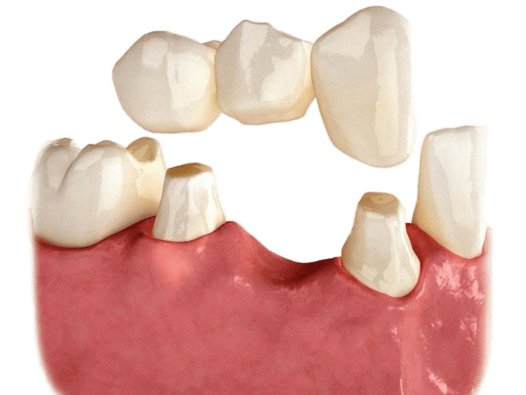Несъемные мостовидные протезы. Зубной мост мостовидный протез. Мостовидные несъемные зубные протезы. Мостовидный протез металлокерамика.