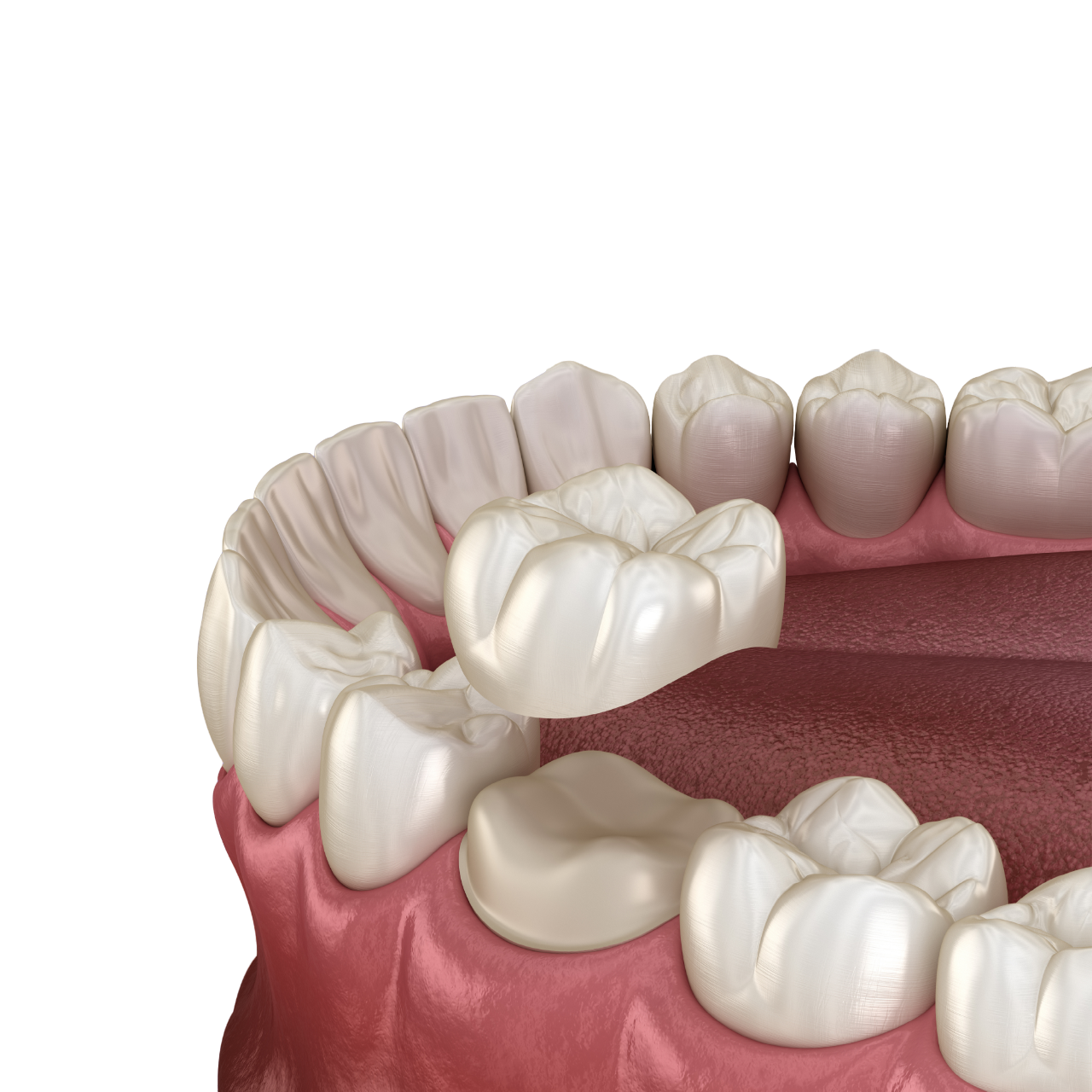 Из чего делают зубные протезы?