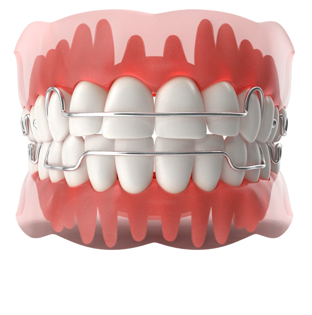 Ортодонтические пластинки для коррекции прикуса