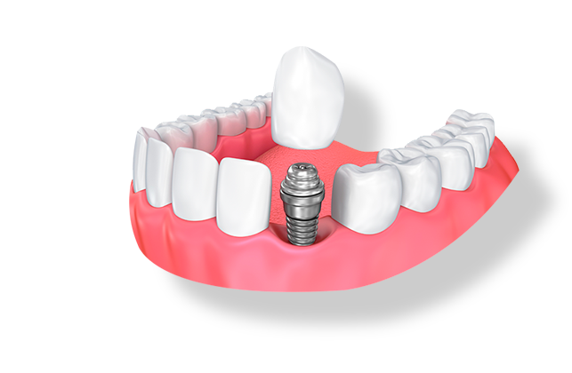 Имплант 1 зуба