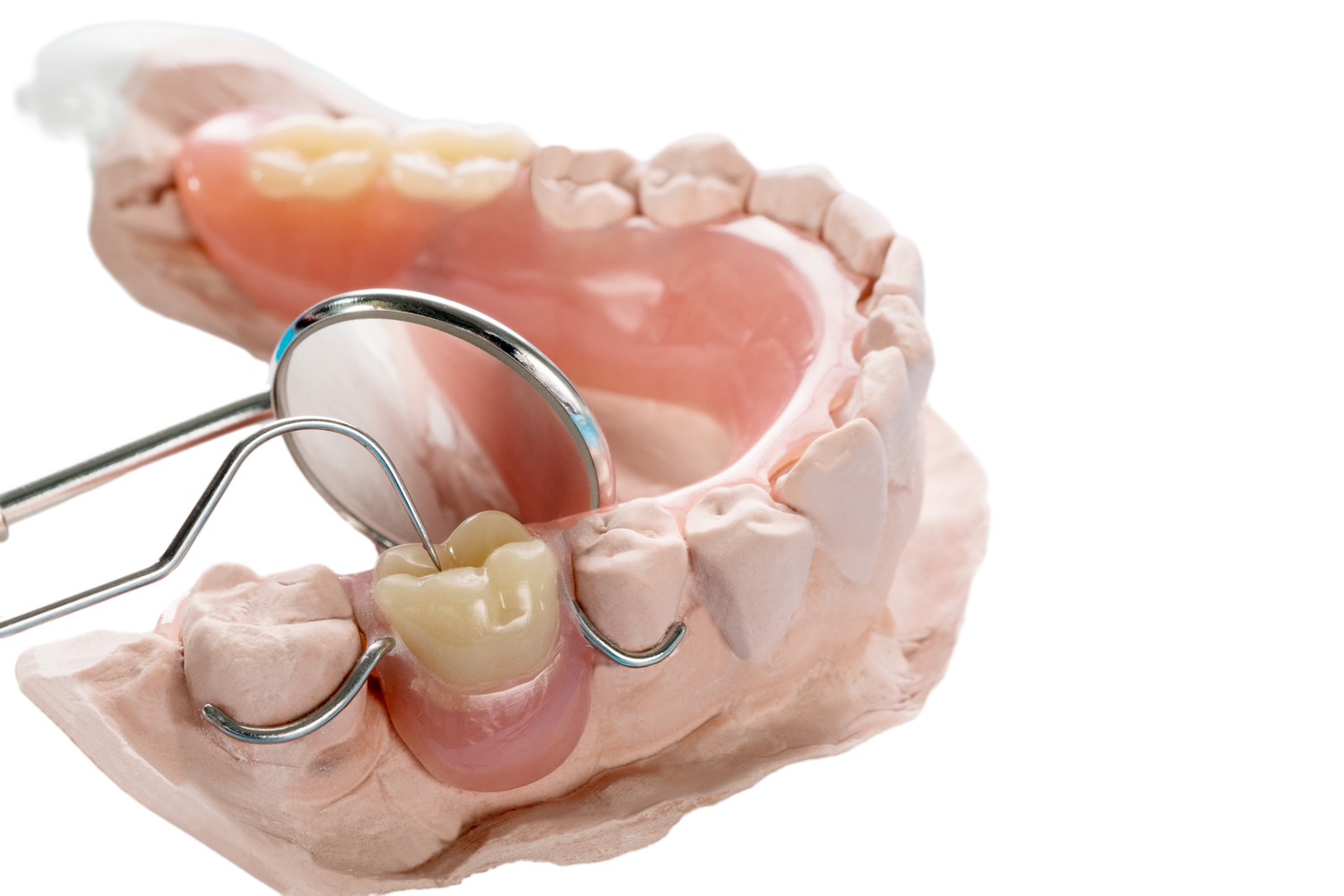 Съемный зубной протез бабочка: цена за один, 2 или 3 зуба в Москве — ROOTT