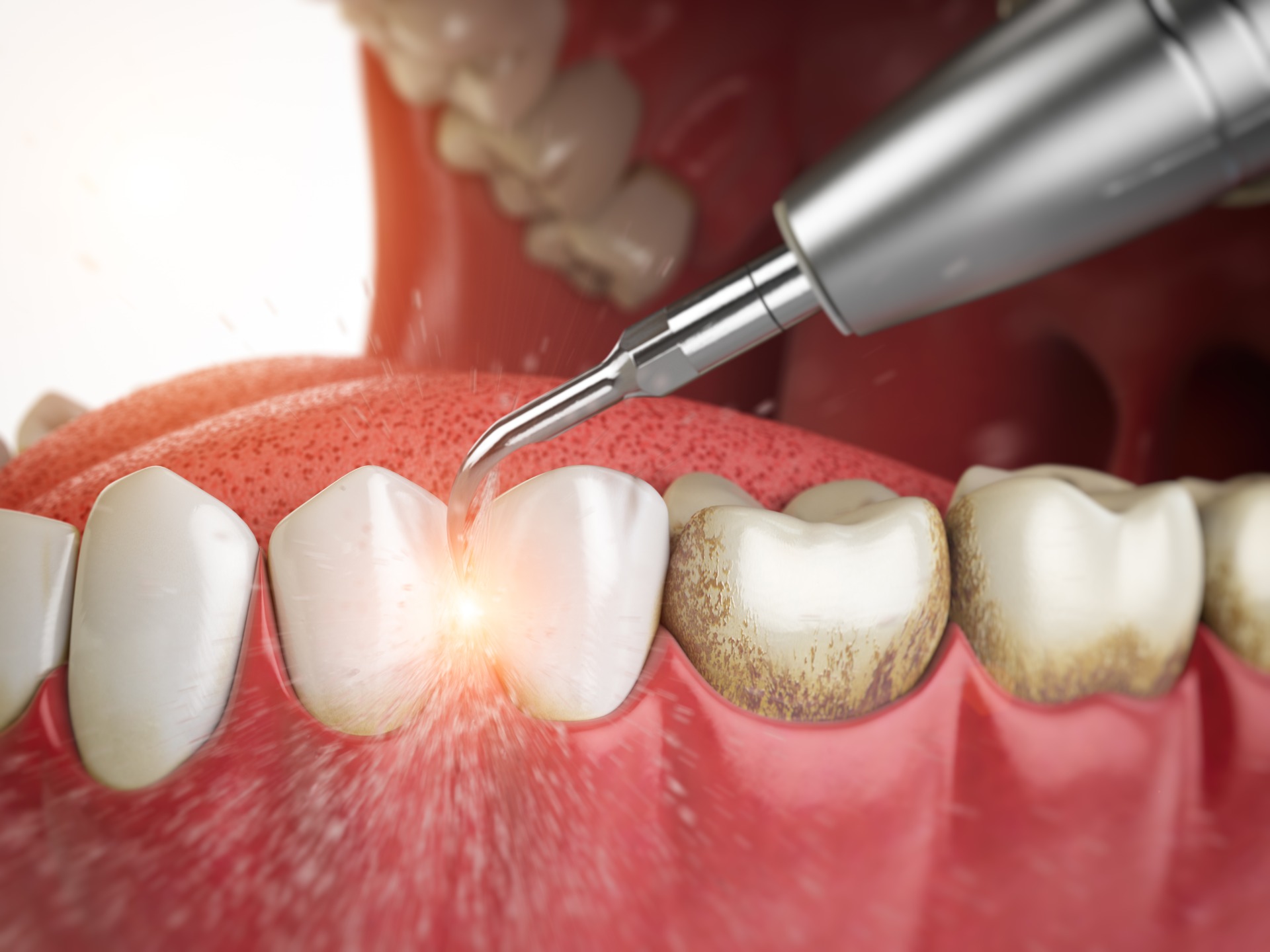 Чистка зуб г. Профгигиена (ультразвук + Air-Flow). Пришеечный зубной камень. Поддесневой зубной налет. Поддесневые отложения зубной камень.