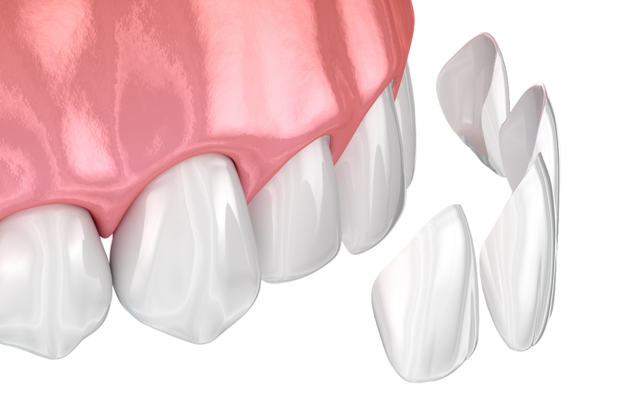 Установка виниров на зубы в Москве по цене от 85 000 рублей