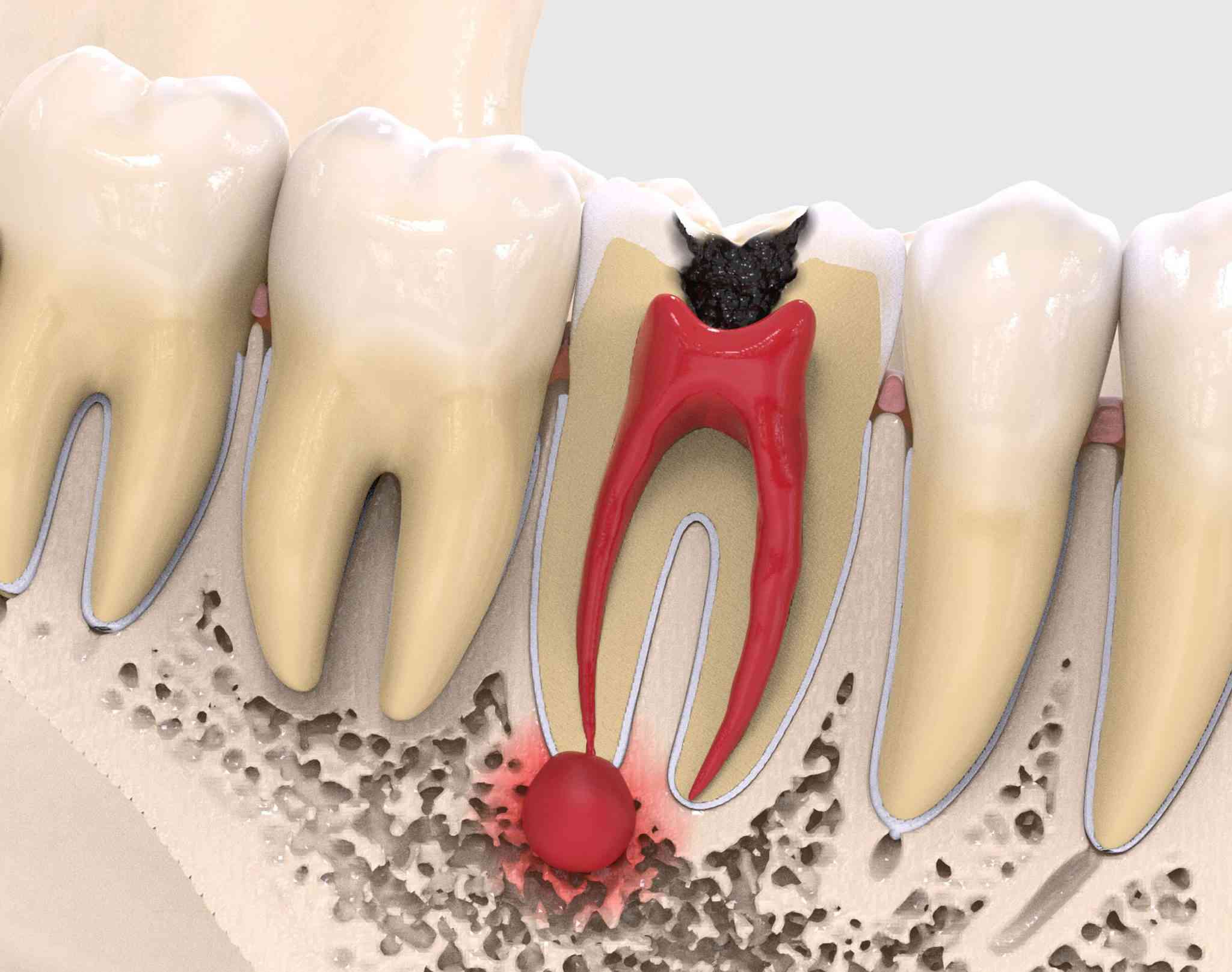 Вопросы о лечении зубной кисты