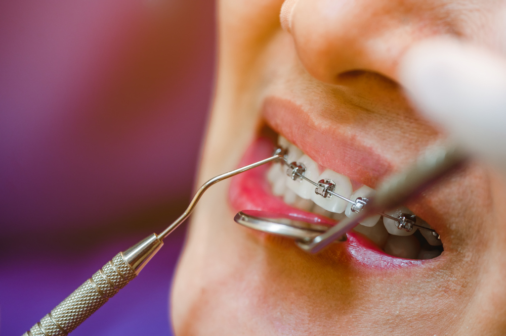Как выровнять зубы без брекетов: два эффективных способа — конференц-зал-самара.рф