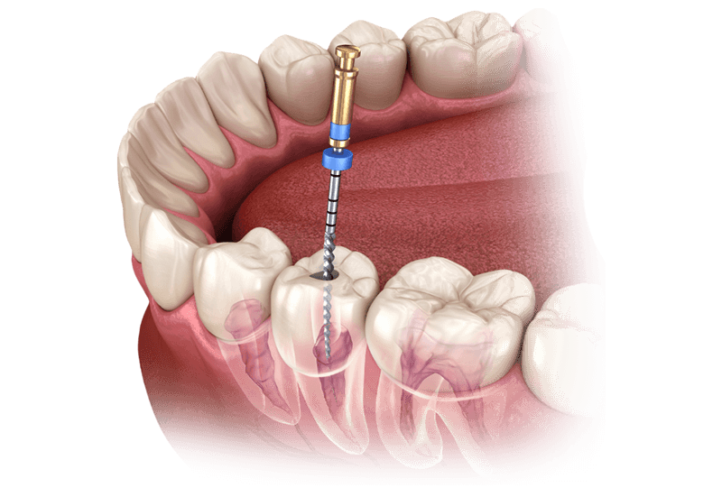 Методики пломбирования каналов зубов