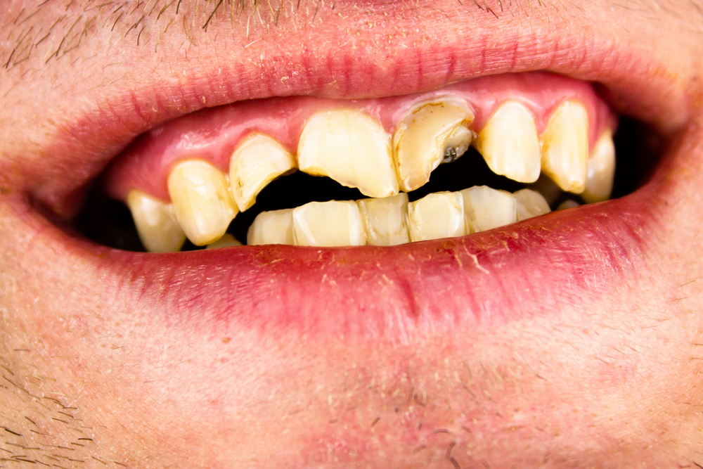Болят передние зубы: причины, лечение