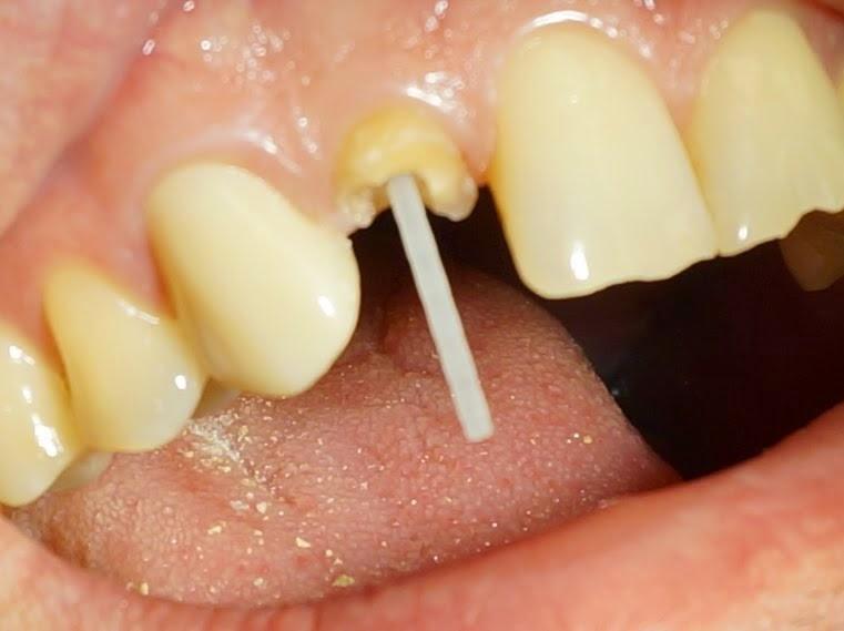 Наращивание зуба на штифт – зуб как новенький | Стоматологическая клиника 32Dent, Киев