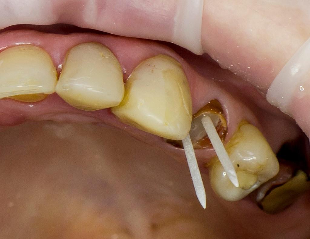 Что делать если шатается зуб у взрослого?