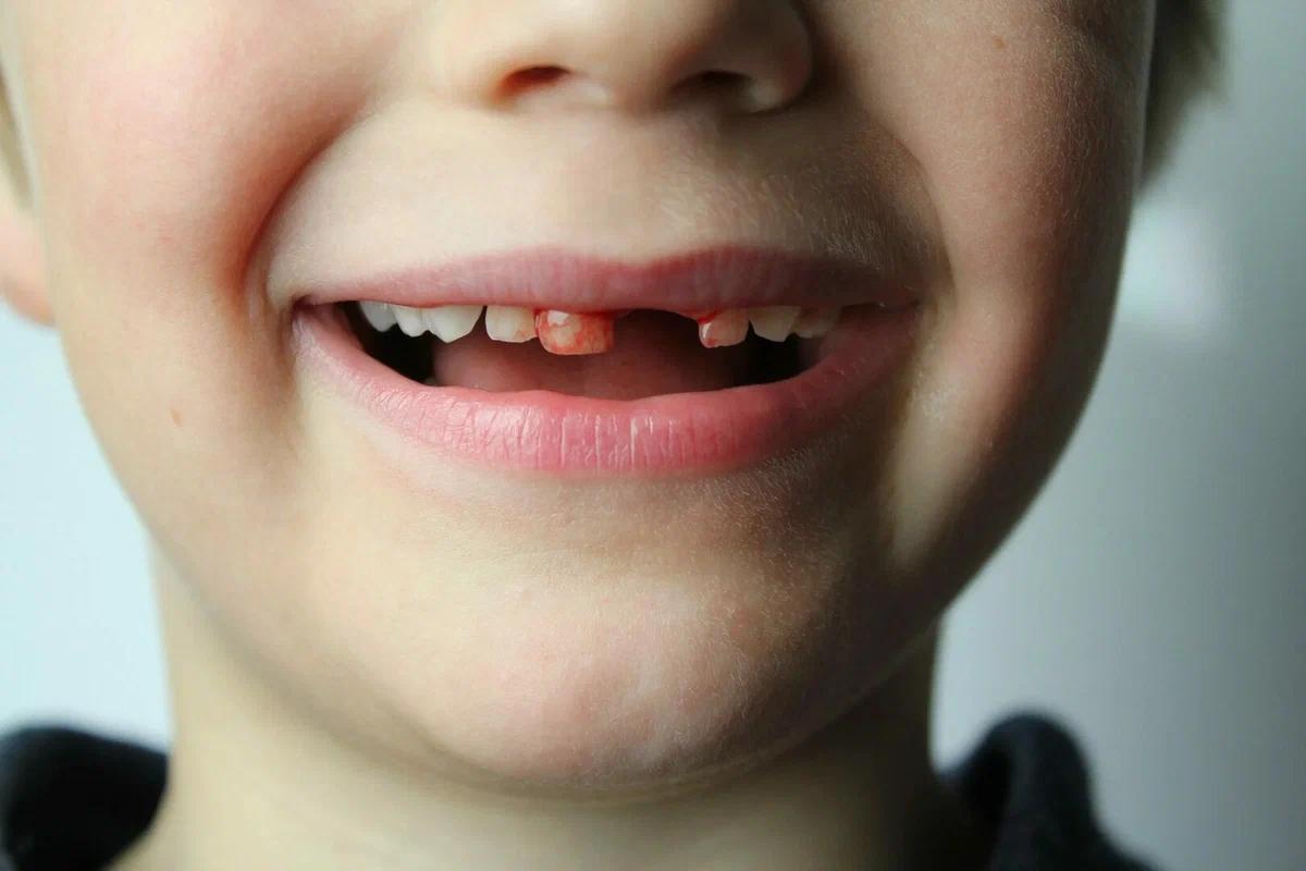 Ребенок выбил, сломал или вывихнул зуб. Что делать?