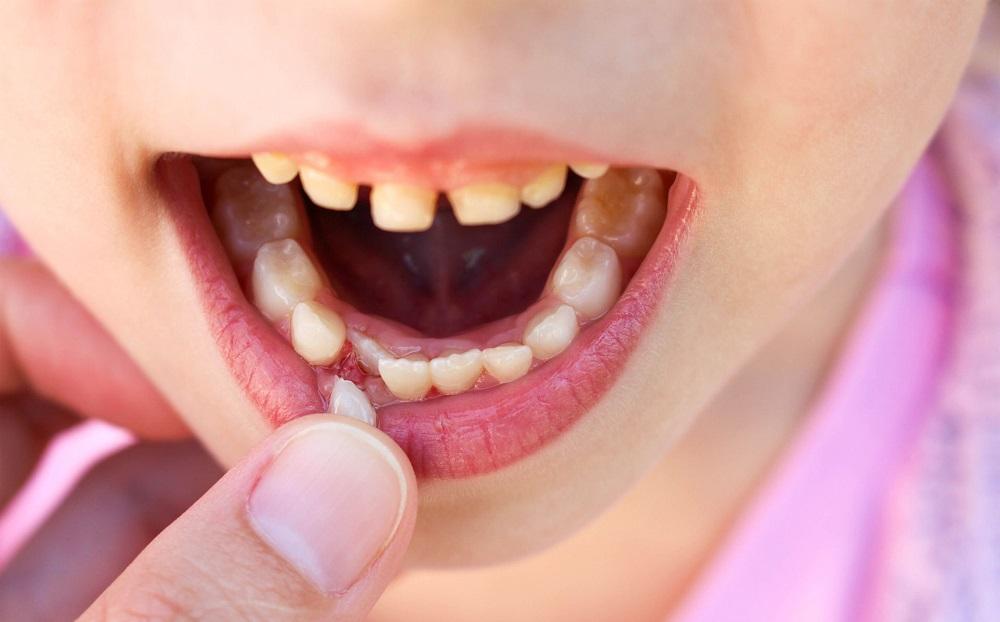 Болит и шатается зуб у ребенка: что делать?
