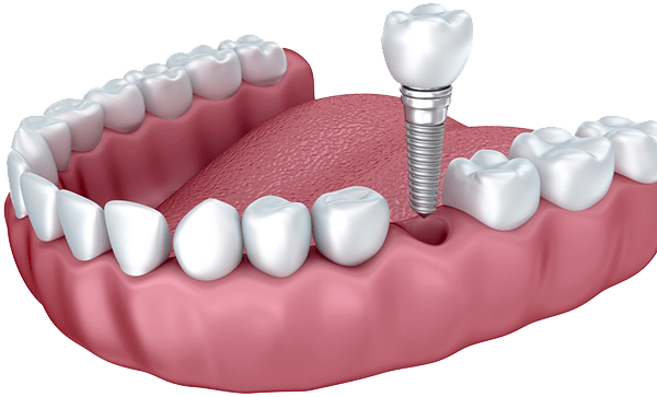 Плюсы имплантации — 10 причин поставить импланты вместо потерянных зубов