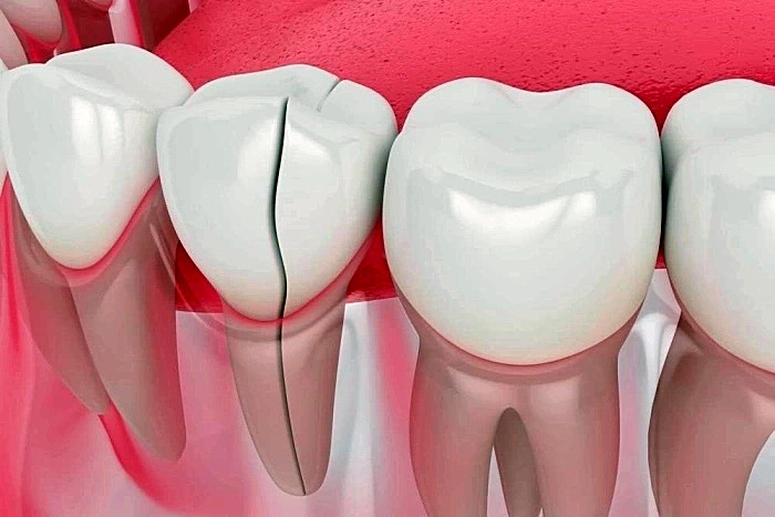 Отторжение зубов после имплантации, симптомы и причины | Стоматология Космодента
