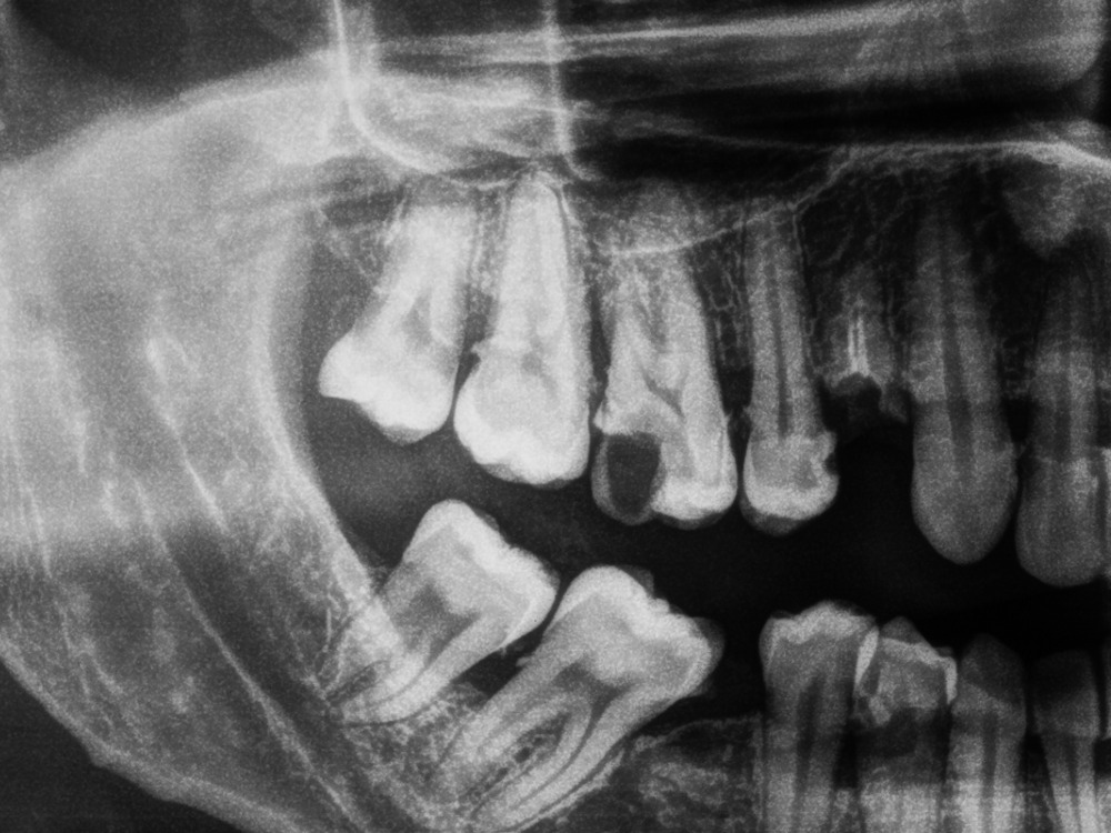 Трещины на зубах, почему появляются, как лечить, трещина или перелом.