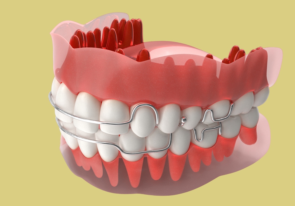 Пластина для выравнивания зубов для детей: принцип работы